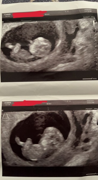 Can anyone guess gender from 12 weeks scan?