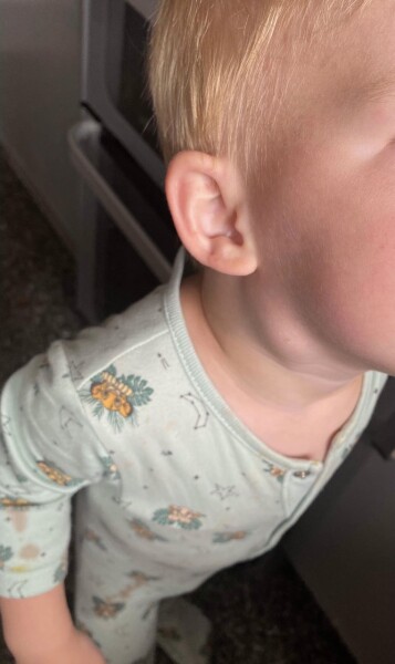 Swollen lymph node
