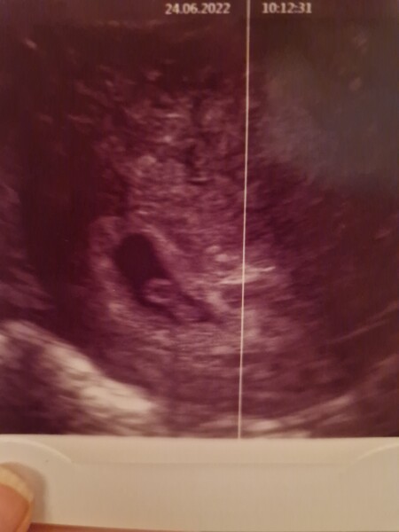 Confused about scans 6 weeks