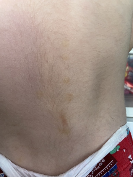 Leukaemia worry 