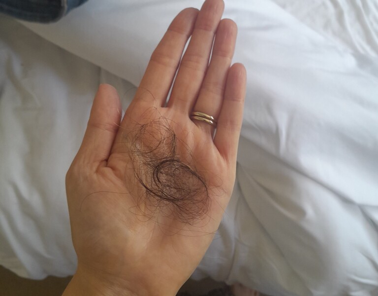 Is this normal hair shedding? Pic attached 
