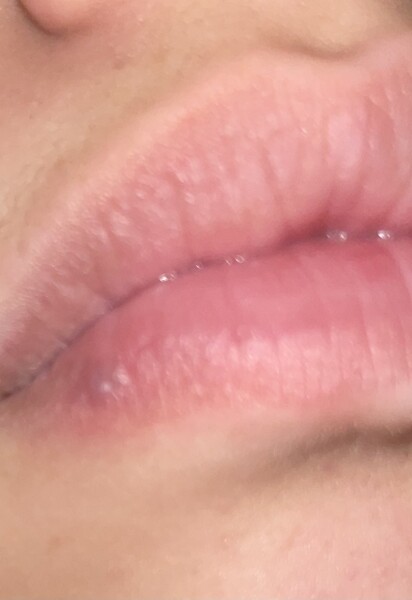 What is this on my lip