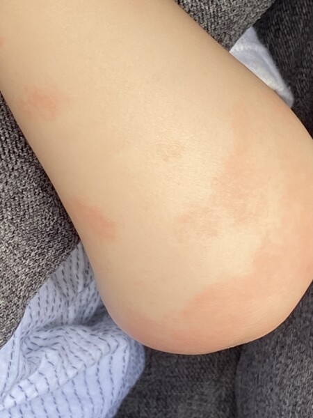Six month old - rash on arms only after eating