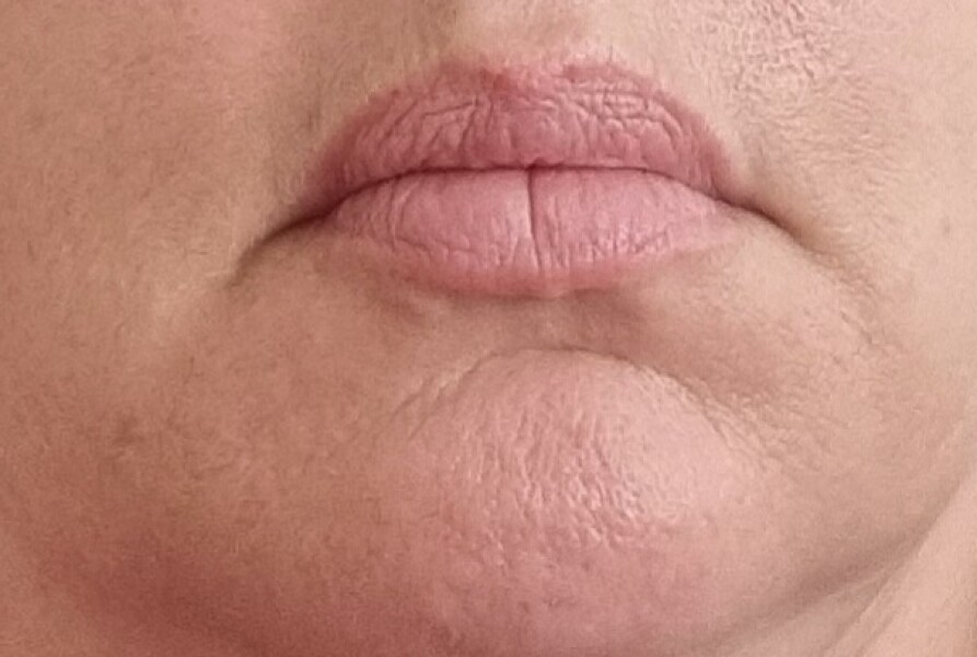 Please talk to me out botox/fillers etc
