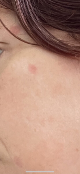 Mole removal from face- any recs?