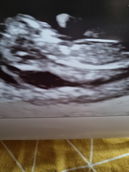 High nuchal scan