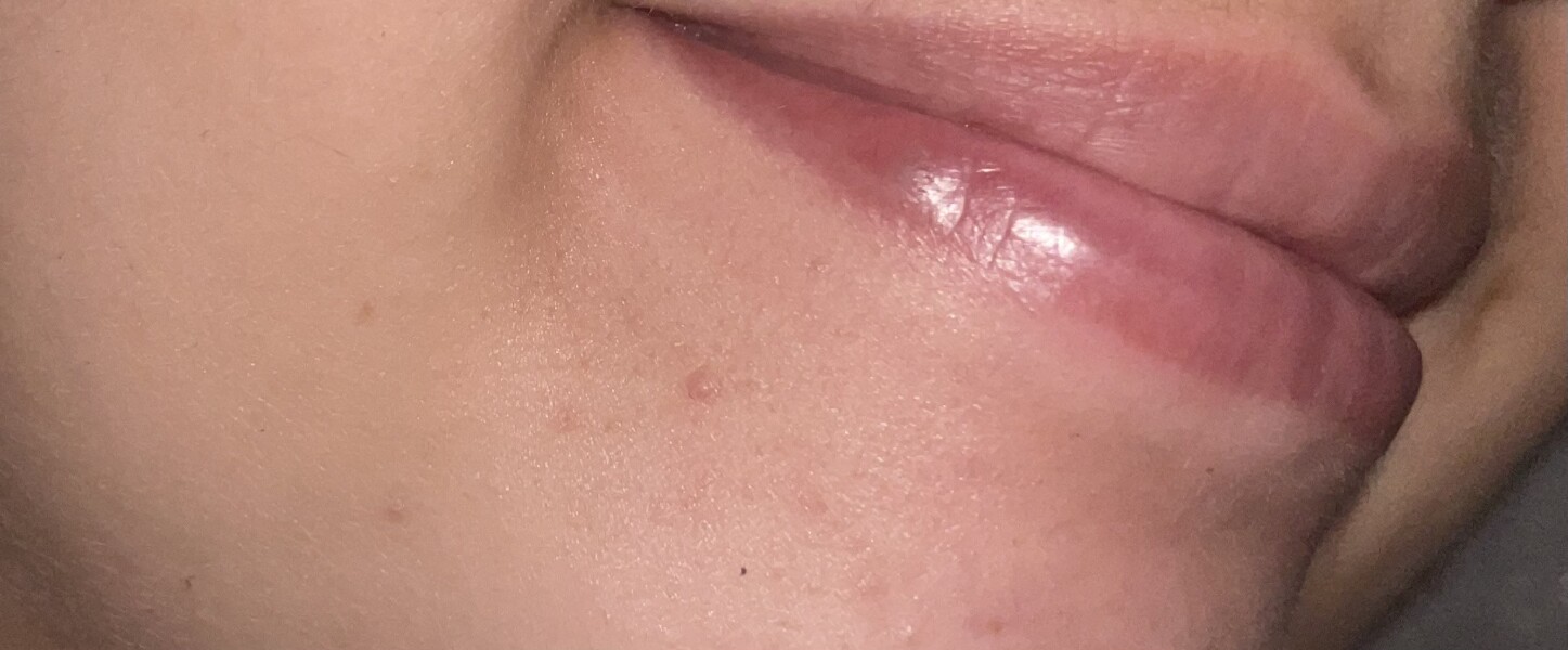 What is this spot on my lip?!?