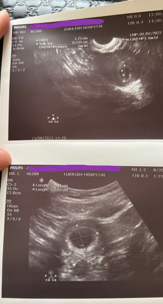 6w6d no heart beat