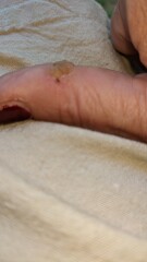 Wart cluster on my thumb is driving me crazy! What wart removal stuff would anyone recommend please.