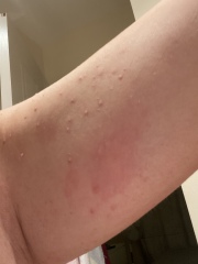 Bitten by something. 