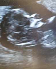12 week scan - Ramzi or Nub Theory help.