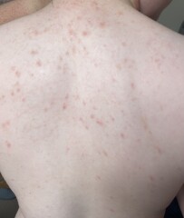 Mystery rash/spots on 10yr old. Any ideas?