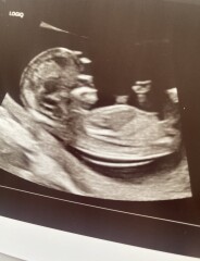 12 Week Scan - Boy or Girl?