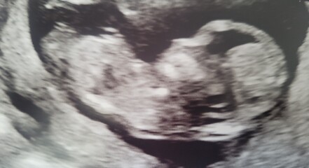 Gender guess - 12 weeks
