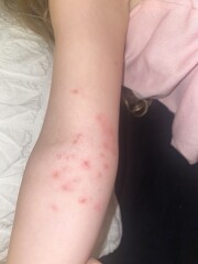Treatment ideas - molluscum contagiosum?
