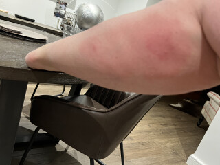 Bite getting bigger....