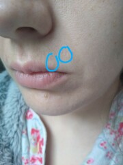 Vertical upper lip lines in my thirties - help!