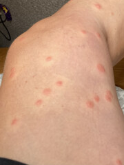 To be worried about this rash?