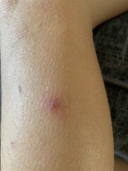 Does this look crusted? (Chicken pox)