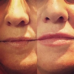 Bit of Filler... husband furious!