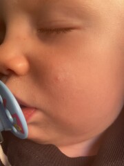 Chicken pox and holiday pending 