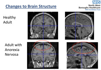 Teen Eating Disorders - Thread 6