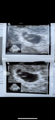 TTC for 10 Months... Am I finally pregnant?