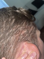 Scalp issues - dermatitis??