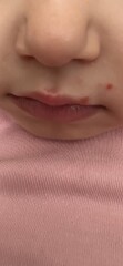 Are these chicken pox ?