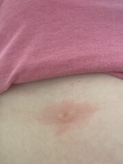 Bite getting bigger....