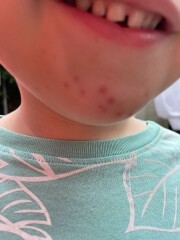 3 year old, same spots on chin for weeks