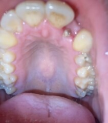 Can a dentist or anyone help please I’m not sure if I have dry socket