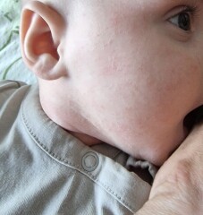 Is this a dribble rash or something else? Help a panicky FTM out!