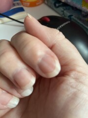 Anyone had a myxoid cyst?