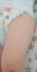 Rash on toddler