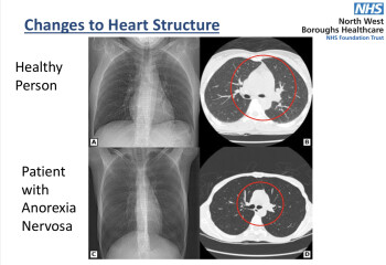 Teen Eating Disorders - Thread 6