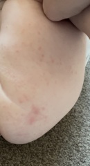 What is this rash?