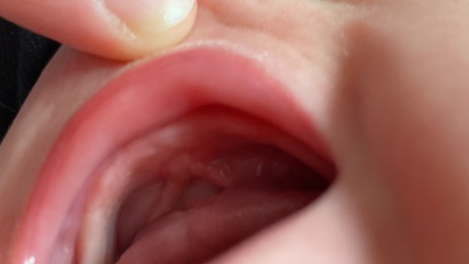 Hard lump or teeth?