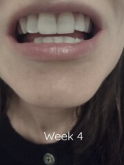 Would you talk to me about teeth whitening?