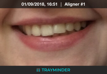To ask if you found Invisalign worth it? 
