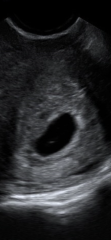 6 week scan no baby seen? 