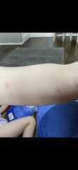 Chicken pox?