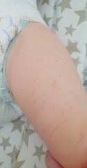 Rash on toddler