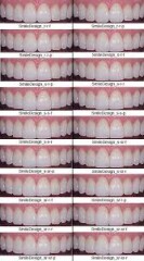 AIBU to ask you to please help with implant teeth choice