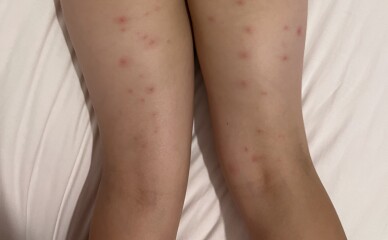 What are these spots - bed bugs?