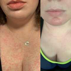 To say some people don’t understand how bad psoriasis and eczema is?