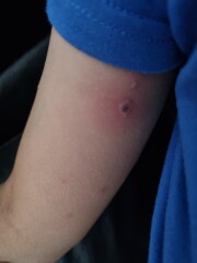 Chickenpox - handhold