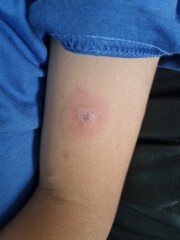 Chickenpox - handhold
