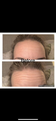 Sad about signs of ageing in 30s, shall I get Botox?