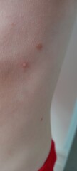 Is this chicken pox?